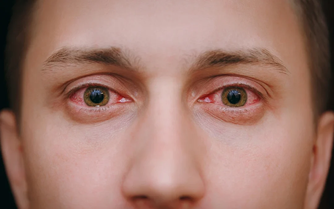 Pink Eye: Symptoms, Causes, & Treatment