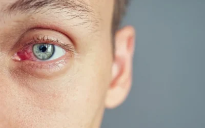 What Causes Red Eyes? When to Call Your Eye Doctor